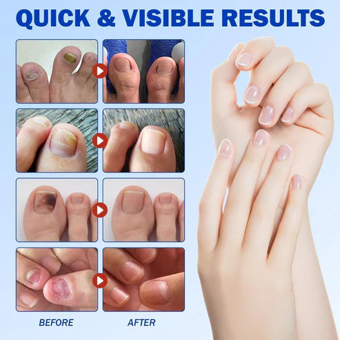 Fungal Nail Patch – Fast Toenail Repair Treatment